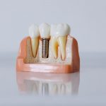 Niedoczynność tarczycy a implanty zębów - co należy wiedzieć na ten temat?