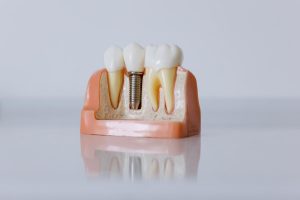 Niedoczynność tarczycy a implanty zębów - co należy wiedzieć na ten temat?
