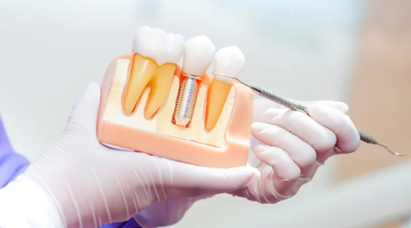 Implanty zębów Lublin