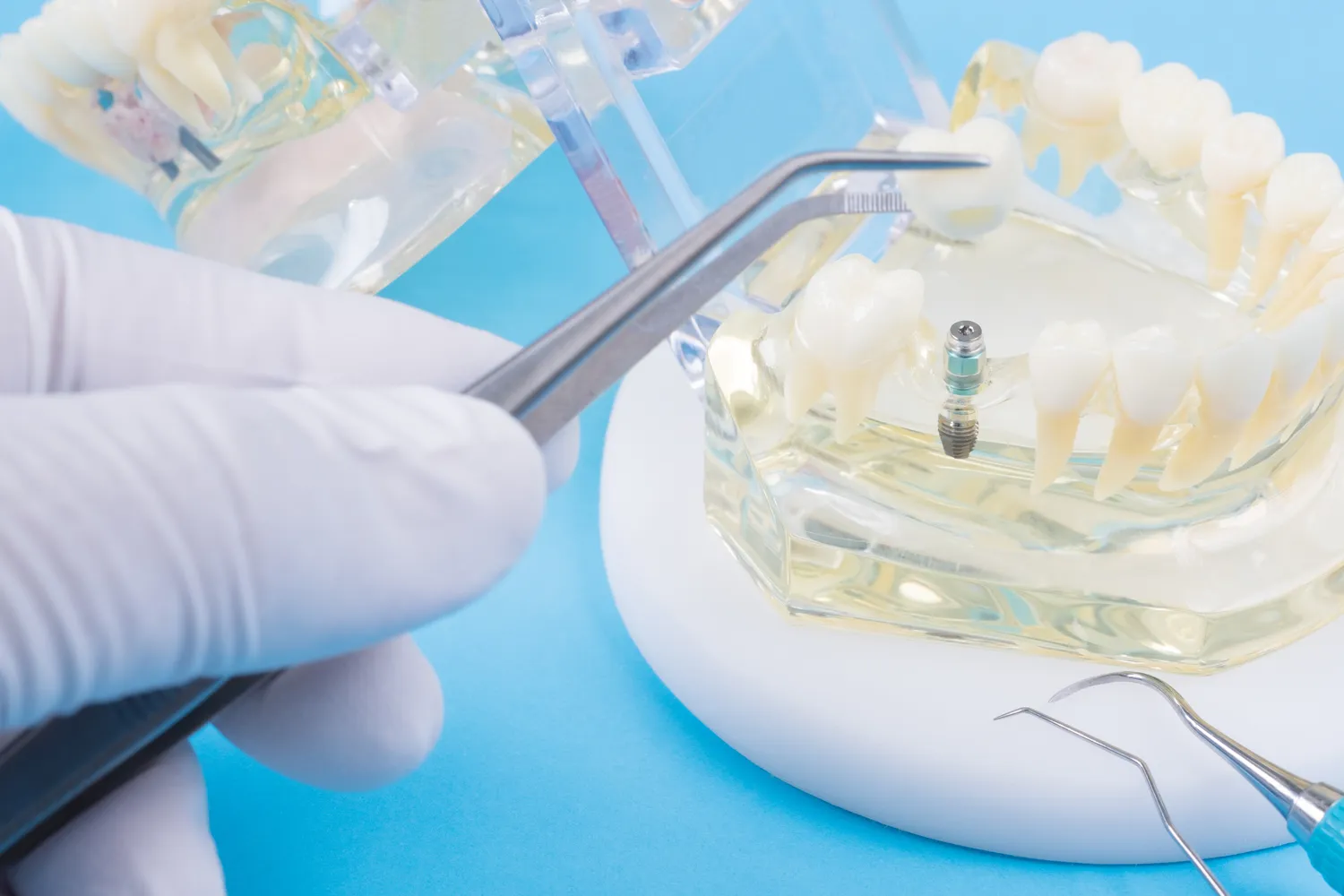 Implanty zębów Szczecin