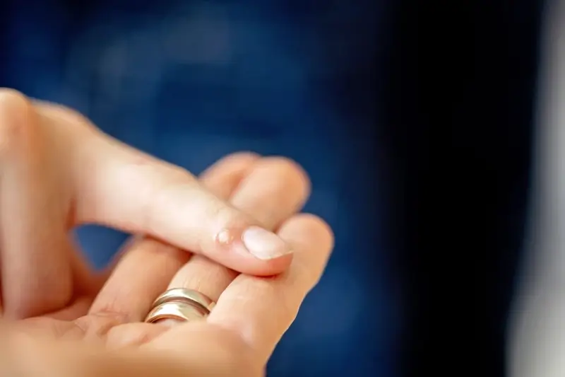 Co jest skuteczne na kurzajki?